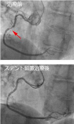 冠動脈治療前 治療後